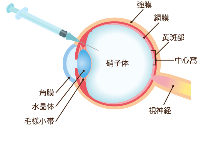 硝子体内注射